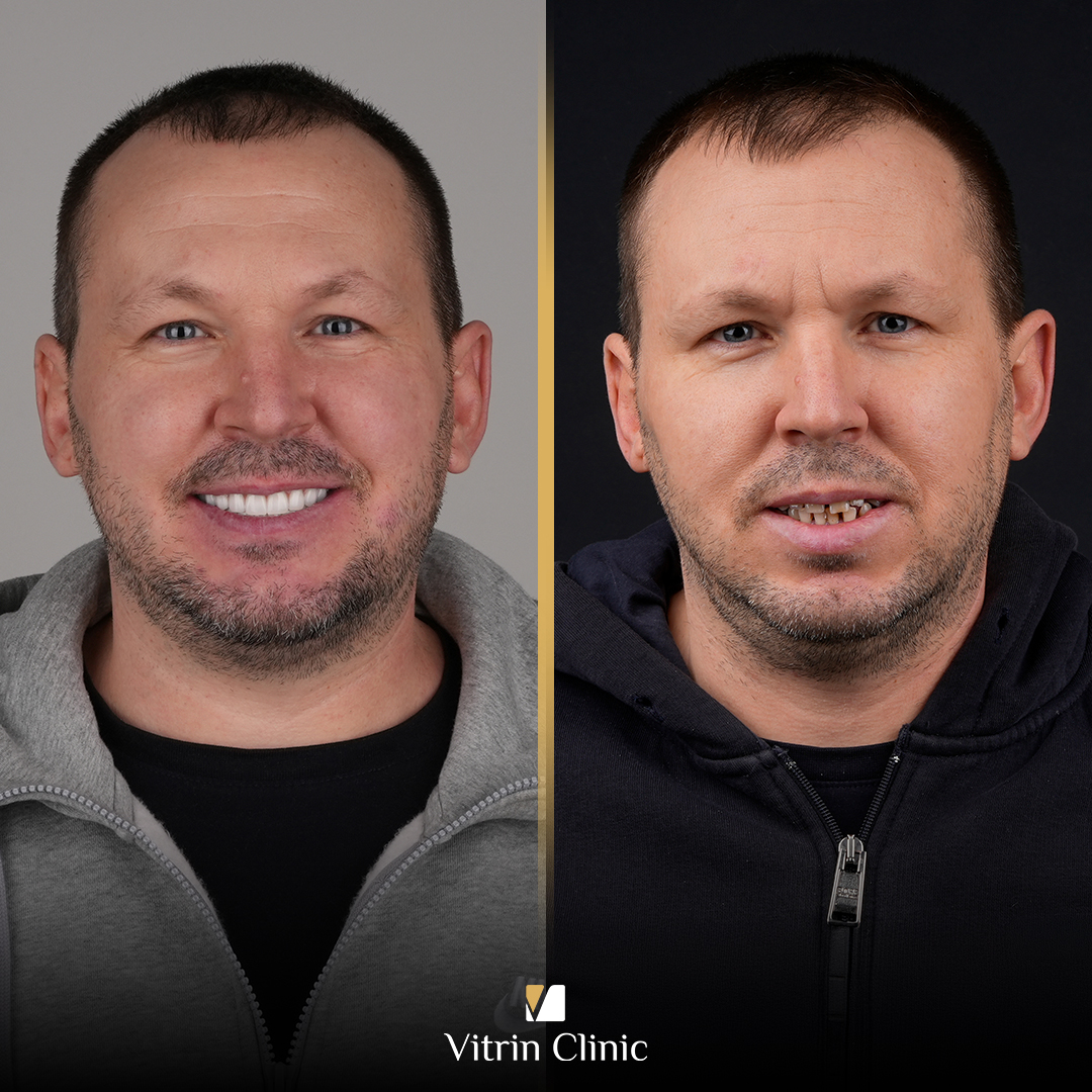 Dmitry dental implants